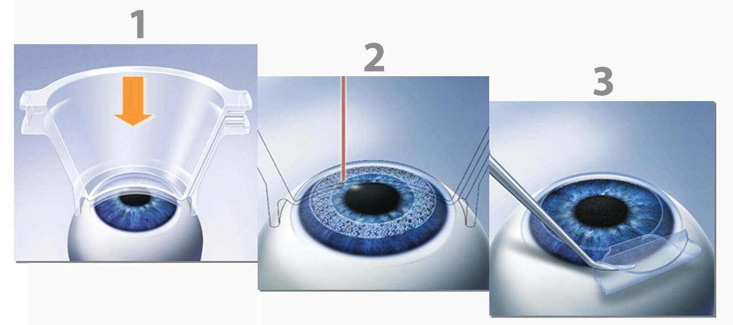 LASIK & Bladeless LASIK Surgery in Shalimar Bagh
