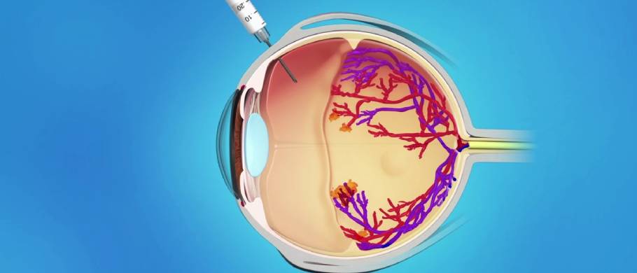 Anti-VEGF Treatment for Retinal Disorders in Model Town