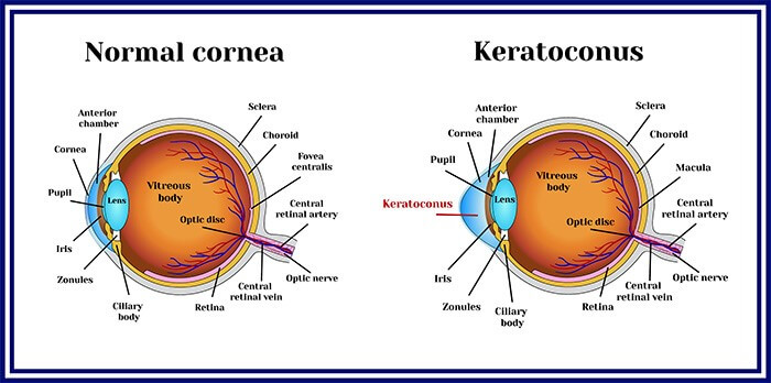 Keratoconus Treatment in Moti Nagar