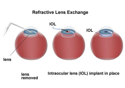 Refractive Lens Exchange Surgery In Shalimar Bagh
