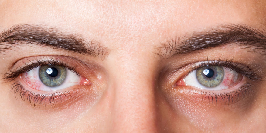 Dry Eye Treatment In Timarpur