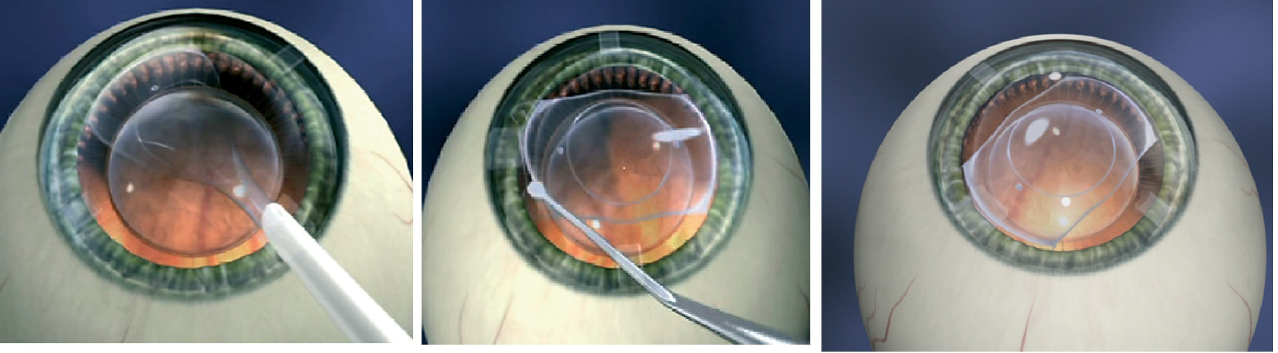 ICL Eye Surgery in Delhi