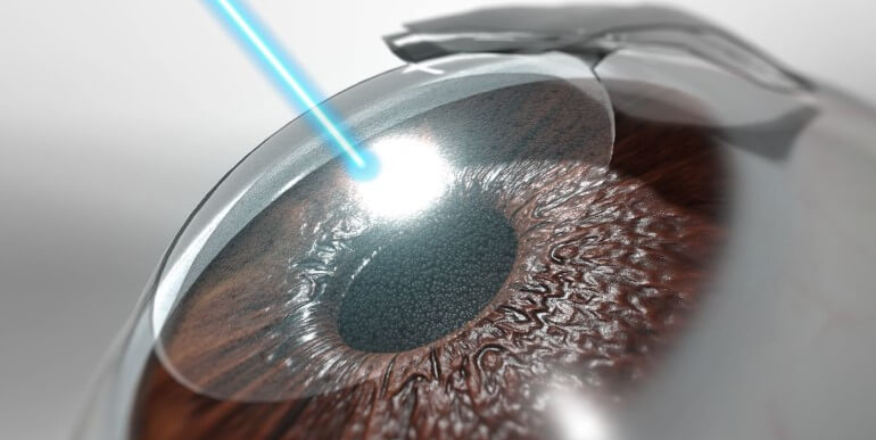 Refractive Eye Surgery in Pitampura