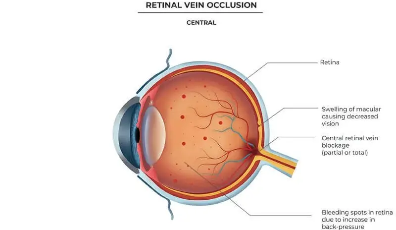 Retinal Vein Occlusion Treatment in Shalimar Bagh